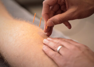 close up of acupuncture treatment being performed on a patient by a practitioner